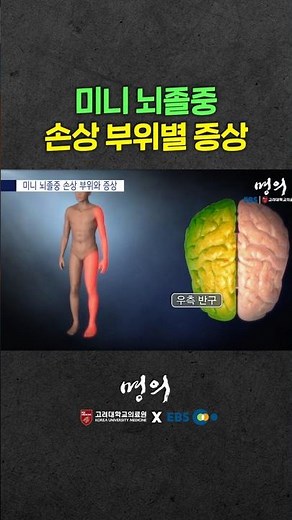 Mini-stroke, symptoms vary by location