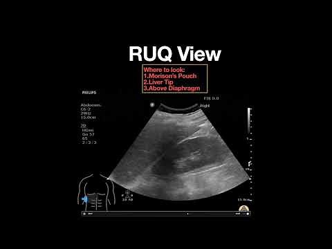 Normal Right Upper Quadrant View