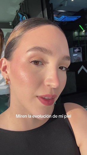 Evolución de mi piel con jabón de azufre y crema 345