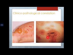 Basic Dermatopathology (14): Algorithm for inflammatory dermatopathology