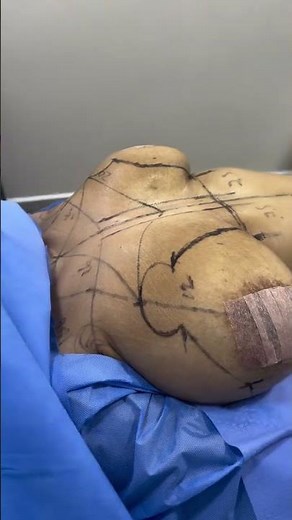 Breast Lift & Implants: The Complete Surgical Guide & Real Transformation Results