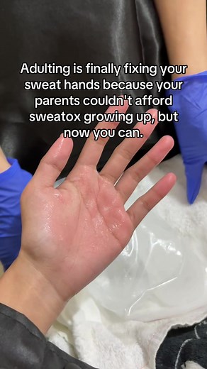 Hyperhidrosis Sweatox: Fixing Sweat Hands for Good