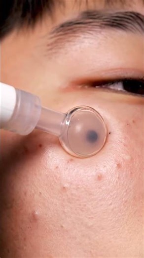 Most Satisfying Pore Cleaning Compilation