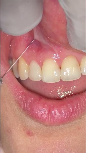 This SIMPLE Trick Changed My Dental Anesthesia Game. HOW TO: Dental Anesthesia for Anterior #teeth