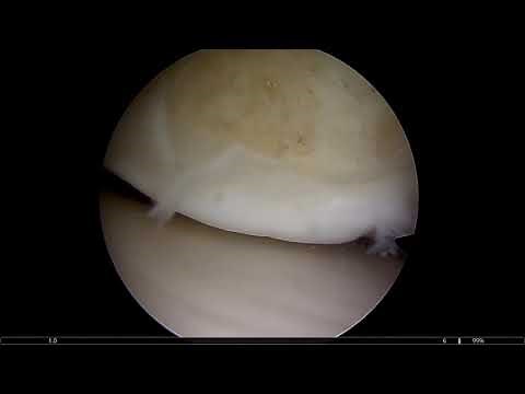 Ankle arthroscopy