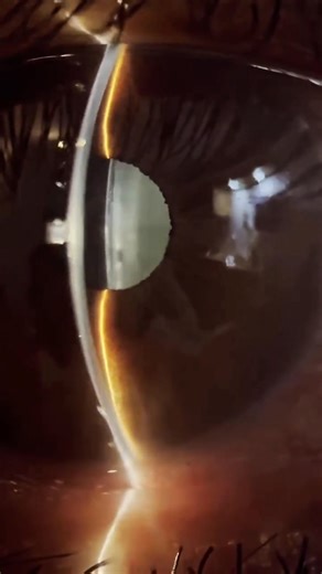 Slit lamp video of the anterior chamber profile, at the periphery of the cornea, showing a narrow space between the cornea and the iris & Gonioscopy. Dr-Muzamil Hussain Baloch | Dr-Muzamil Hussain Baloch