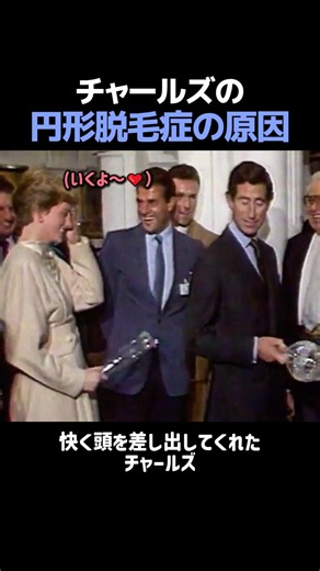 チャールズの脱毛症の意外な原因