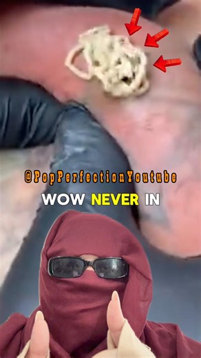 Huge back pimple! 😍 #oddlysatisfying #pimples #blackheads #reaction #acne #satisfying #pimplepop