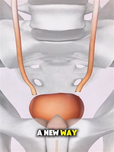 Understanding Bladder Cancer Surgery through 3D Animation