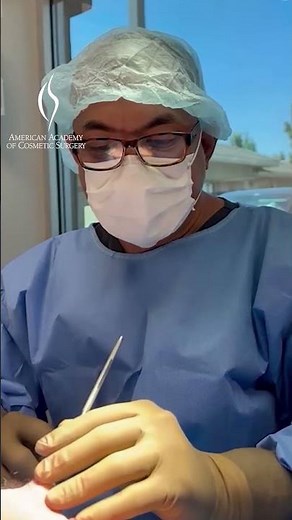 Facelift Under Local Anesthesia: A Pain-Free Transformation! #medicaleducation #deepplanefacelift