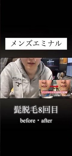 メンズエミナルのヒゲ脱毛8回目の効果！before・afterを公開