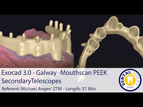 2021-Exocad - Tutorial Preview-Exocad 3.0 – Galway Mouthscan PEEK Secondary Telescopes