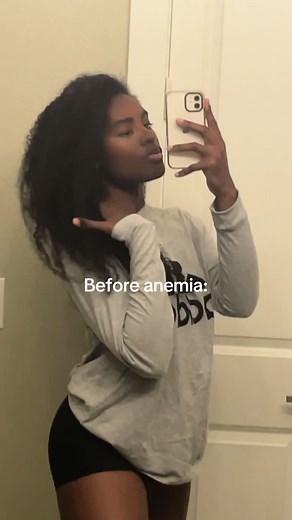 Embracing Change: My Hair Growth Journey After Anemia