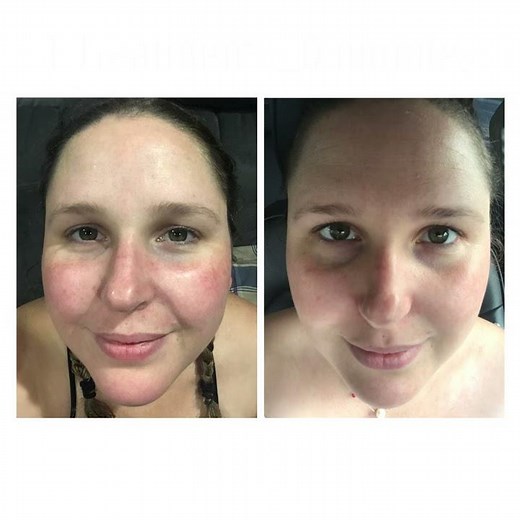 Before and After Images Using Celluma only Once