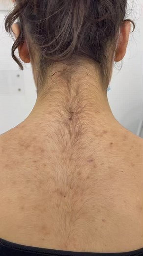 Rodines Laser: Alexandrite Lasertime Explored