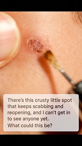 57K views · 113 reactions | There’s this crusty little spot that keeps scabbing and reopening, and I can’t get in to see anyone yet. What could this be? | Useful Tips | Facebook