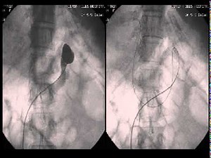 Balloon Retrograde Transvenous Occlusion (BRTO)