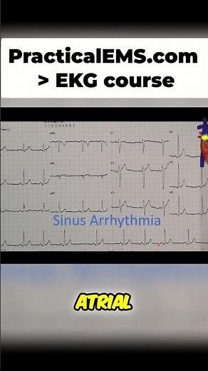 Sinus Arrhythmia Explained: Spotting Irregular Heart Rhythms