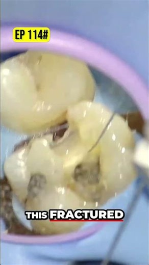 Navigating Dental Challenges File Technique Revealed!