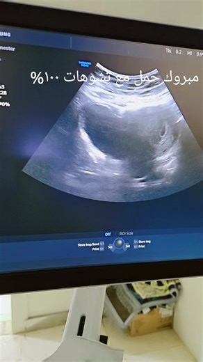 بشارة حمل مميزة مع مفاجآت سارة