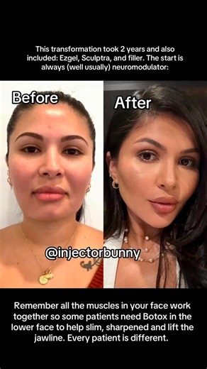 Erika Barry on Instagram: "The most beautiful patient and talented injector @injectordarlin …. - Why do I sometimes inject the masseters to help light and tighten the neck and jawline. ✨✨ comment. “Bunny Patreon” and I’ll send the link “✨✨ - Masseter tox is included in some of myadvanced tox neck lift because reducing downward and lateral tension from the masseter muscle improves mandibular contour, decreases lower-face bulk, 😱 rebalances forces acting on the platysma and mandibular ligament sy