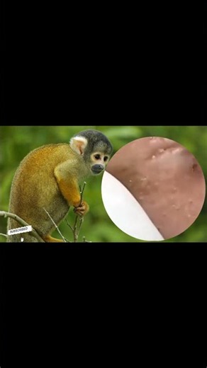 Removing Acne Blackheads on skin, cleaning everywhere