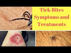 Tick Bites Symptoms and Treatments.