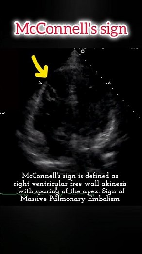 McConnell's sign is defined as right ventricular free wall akinesis with sparing of the apex #heart