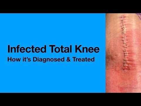 Infected Total Knee Replacement. A dreaded complication. What you need to know.