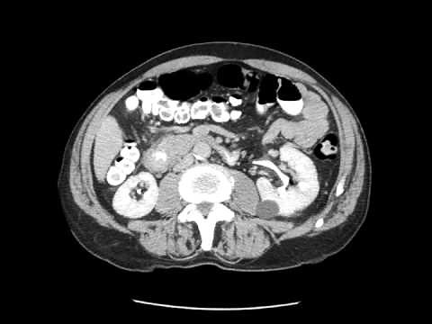 Duodenal adenocarcinoma