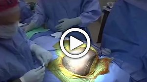 Scapula Plating System