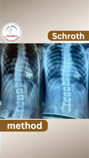 Schroth therapy #vertebroloq