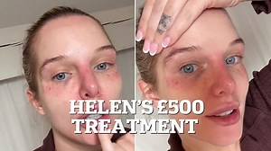 Helen Flanagan shows off painful bruising after her £500 filler