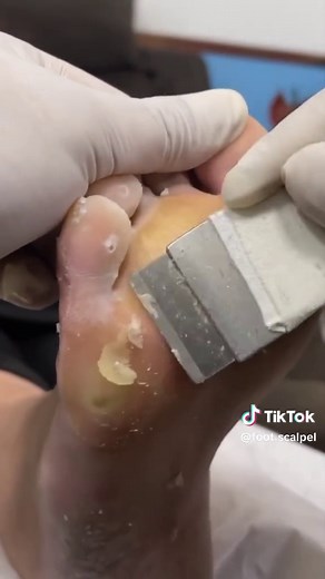 Thoroughly Cleaning Super Thick Dead Skin on Feet