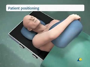 Olecranon—transverse fracture 21-B1 tension band wiring