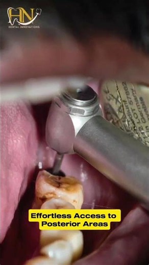 Effortless Access To Posterior Areas Using DG Torque X Pro