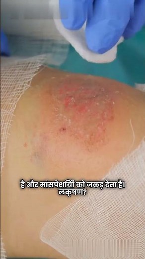 Tetanus Explained in 1 Minute | Causes, Symptoms & Prevention | Health Facts#health #awareness