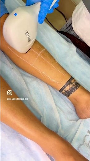 Laser Hair Reduction Facts You Didn’t Know | Safe & Effective LHR Explained