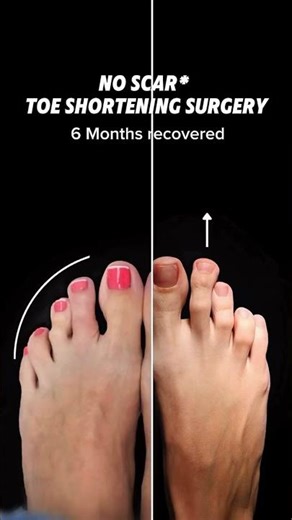 NO VISIBLE SCAR TOE SHORTENING SURGERY