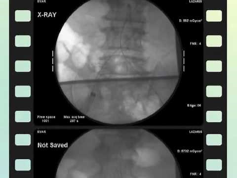 Endovascular AAA repair - Medtronic Endurant