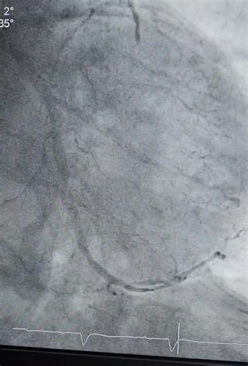 #cardiology #interventionalcardiology #complexpci #rotablation #dcb #nstemi #revascularization #cathlabteamwork #patientcare #cardiacintervention #lowcontrastpci #agik | Mohammad Jumah