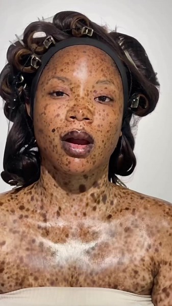 Vitiligo queen 😇✨♥️♥️ #vitiligogirl #makeup #vitiligomakeup #makeupartistinsurulere