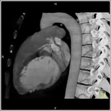 Vascular:Normal coronary MIP:Maximum intensity projection to visualize the coronary arteries(2 of 3)