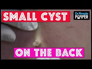 A Nice Little Punch to the Back... Cyst