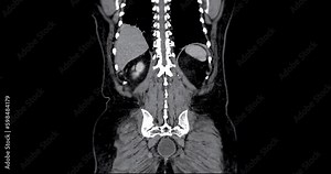 CT whole abdomen with contrast media for diagnosis chest and abdominal pain.