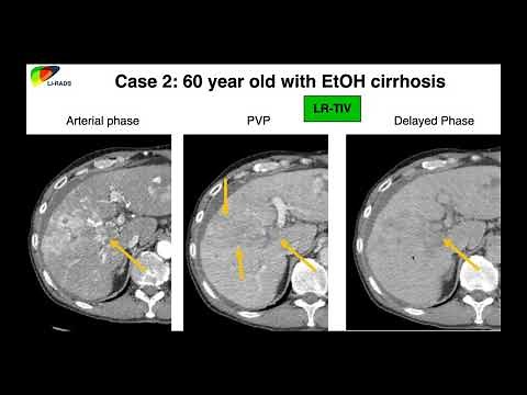 17. LI-RADS Case-based Review - Part 1. By Dr. Ania Kielar
