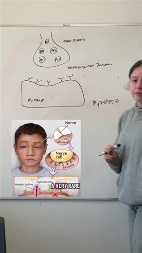 myasthenia gravis, autoimmune disorder of the neuromuscular junction. #neuroscscience #student #college #stem #medicine
