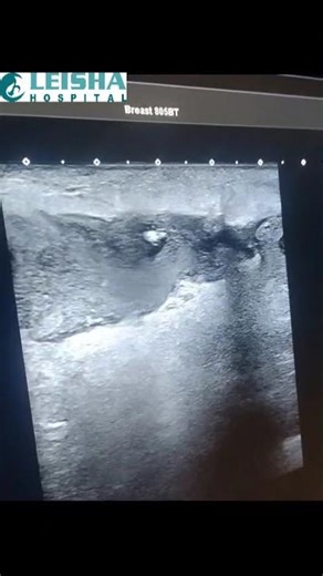 Ultrasound imaging guided Breast abscess aspiration