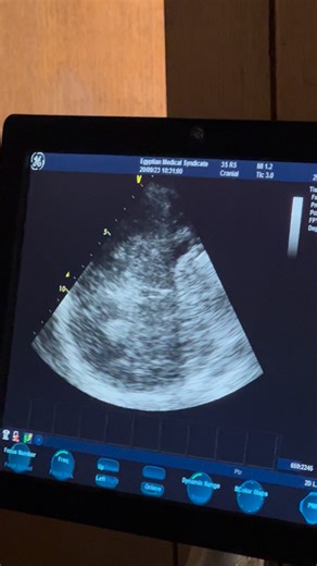 Video demonstrating the localization of midbrain, third ventricle, lateral ventricle, and measurement of midline shift. For registration in our Hands on Adult Brain U/S and TCCD Course in Egyptian Medical Syndicate. For registration in the coming course, kindly contact Dr Doaa, the scientific coordinator on 00201065468005 WhatsApp. For registration in our recorded courses, kindly contact us on 00201023501450 WhatsApp | Hands on critical care U/S courses