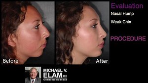 Changing Your Profile With a Rhinoplasty and Chin Implant